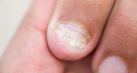 Grzybica paznokci u rąk – rodzaje i objawy. Czy można ją leczyć domowymi sposobami?