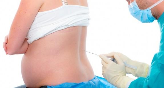 Znieczulenie zewnątrzoponowe przy porodzie: wady, zalety, możliwe powikłania